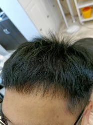 -大麦微针植发丨全国连锁