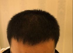 -大麦微针植发丨全国连锁