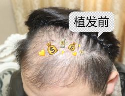 -大麦微针植发全国连锁