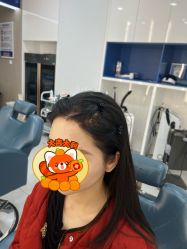 体验后-大麦微针植发全国连锁