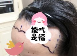 -大麦微针植发全国连锁