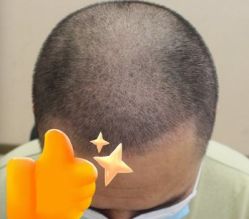 -大麦微针植发丨全国连锁