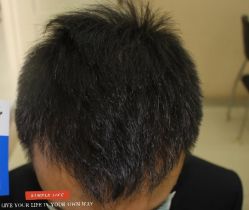 -大麦微针植发丨全国连锁