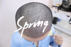 体验后-大麦微针植发全国连锁