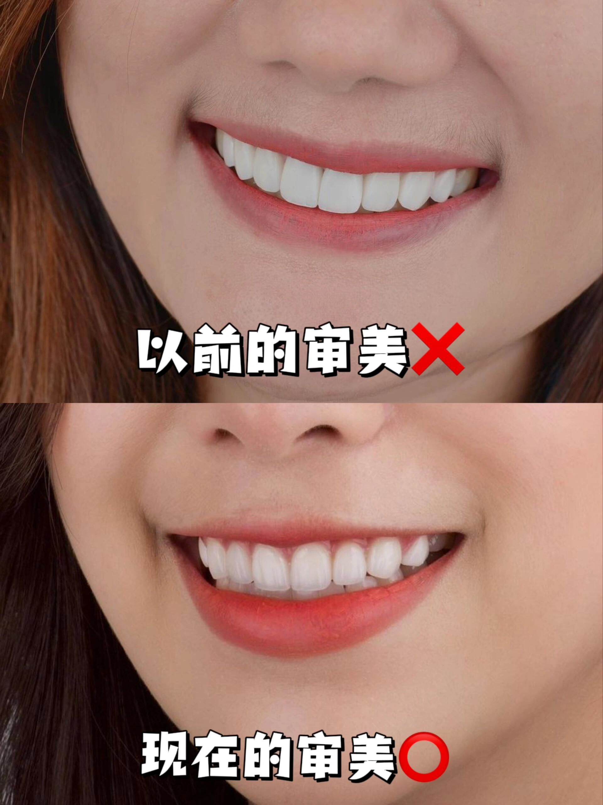 牙齿贴面不是简单的美白 !