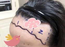 -大麦微针植发全国连锁