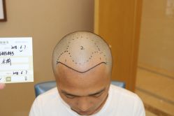 -大麦微针植发丨全国连锁