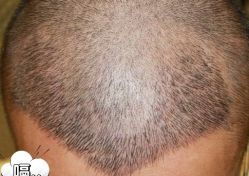 -大麦微针植发丨全国连锁