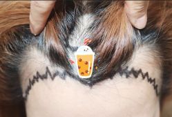 -大麦微针植发全国连锁