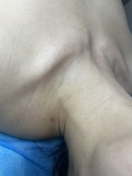 -美丽人生祛斑扁平疣汗管瘤中心