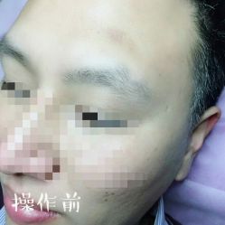 -西施无菌半永久纹绣眉眼影唇轻增发纹发际线
