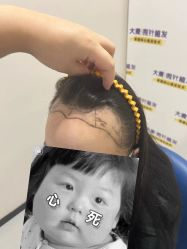 体验前-大麦微针植发全国连锁