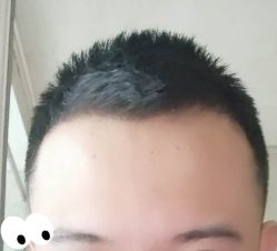 -大麦微针植发丨全国连锁