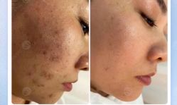 -美肤盾祛痘·问题肌头疗管理中心