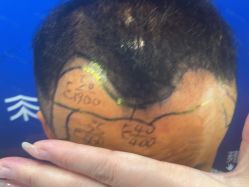 -雍禾植发全国连锁