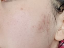 体验前-正璞医疗美容·皮肤修复·微整注射