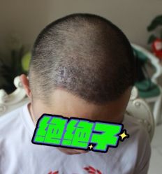 -大麦微针植发丨全国连锁