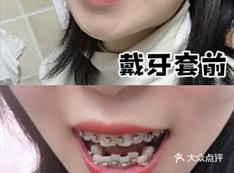 做金属矫正你会后悔吗？
