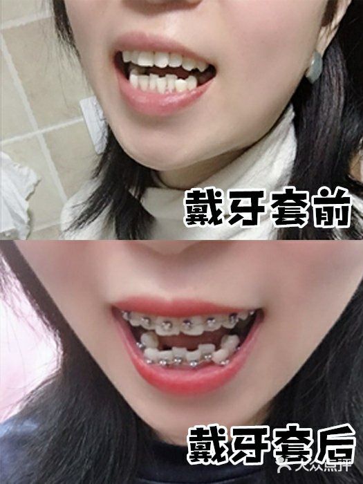 做金属矫正你会后悔吗？