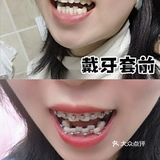 做金属矫正你会后悔吗？