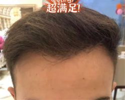 -大麦微针植发全国连锁