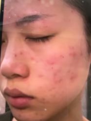 体验前-蕾特恩专业祛痘·皮肤管理