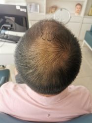 -大麦微针植发丨全国连锁