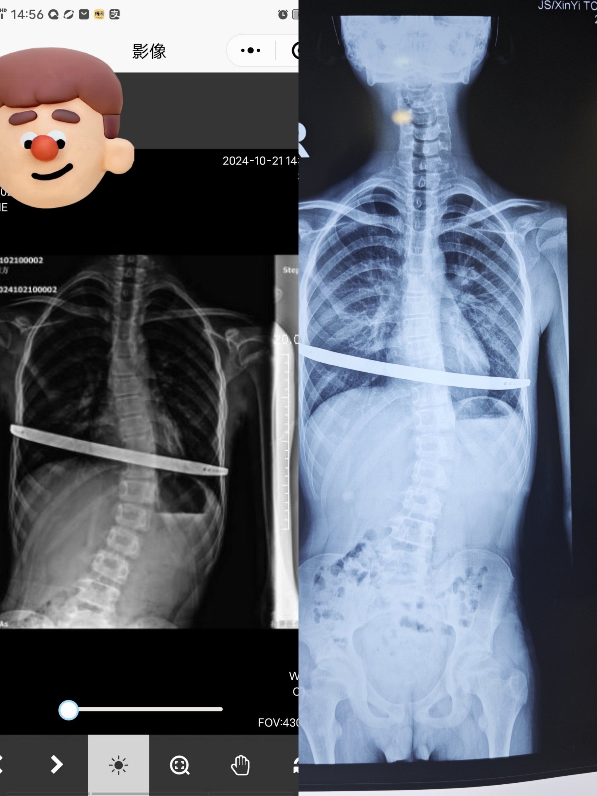 成长轨迹:骨骼x光对比