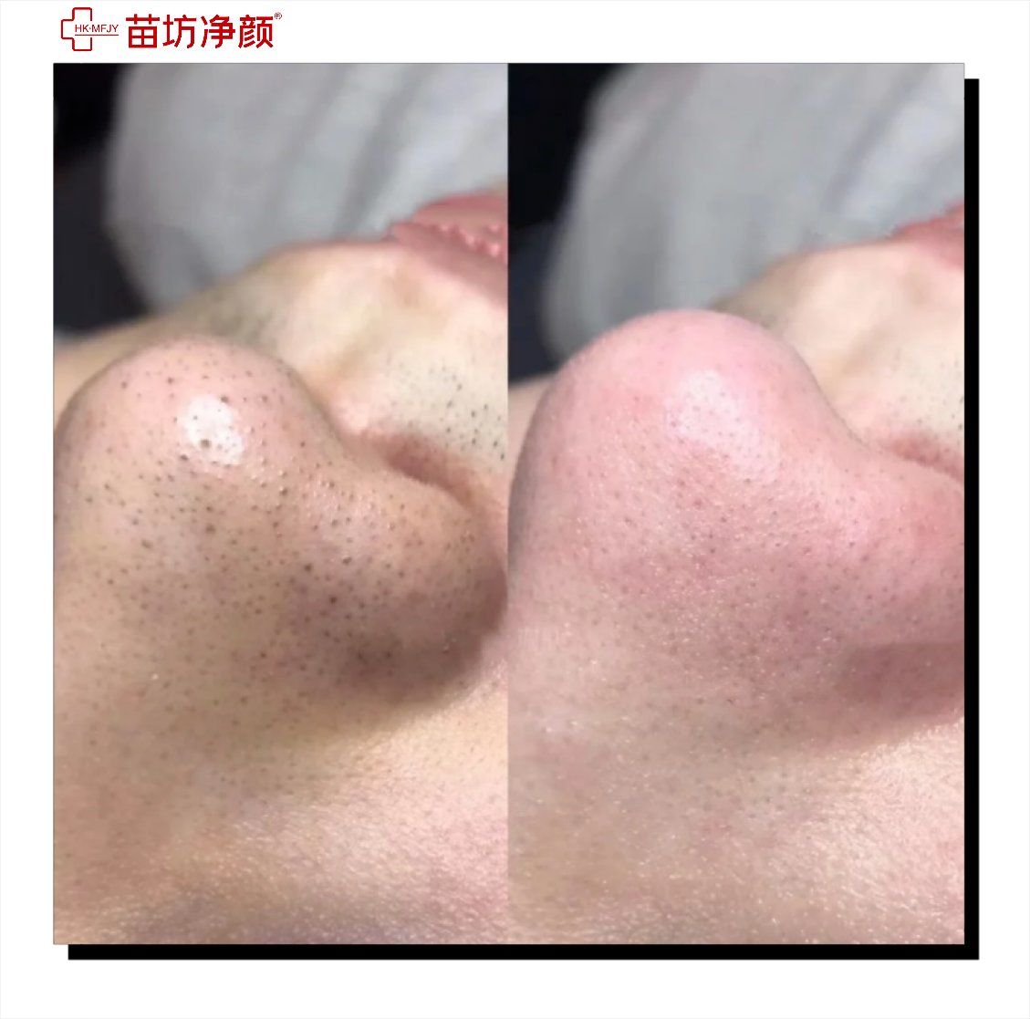 黑头前面的对比