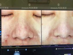 -苑苑vbeauty科技美容SPA