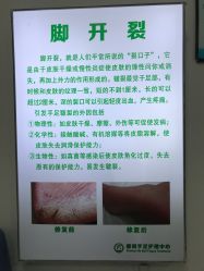 -德哥灰指甲脚气甲沟炎跖疣护理