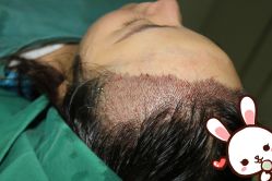 -大麦微针植发丨全国连锁