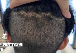 -大麦微针植发全国连锁