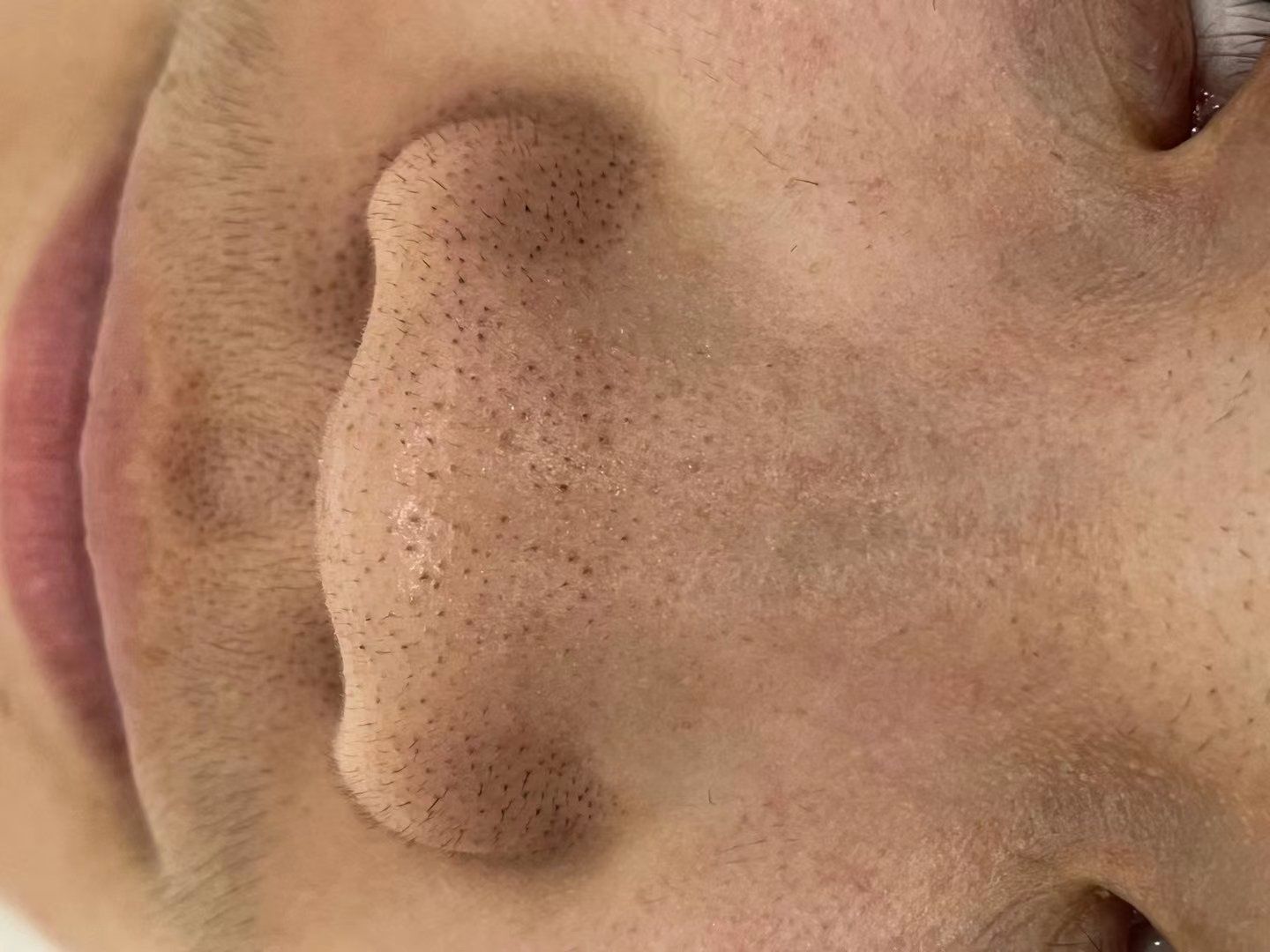 什么叫毳毛黑头?