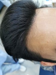 -大麦微针植发全国连锁