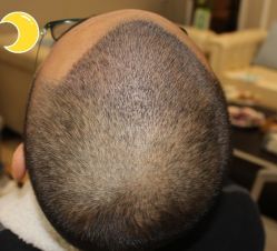 -大麦微针植发丨全国连锁