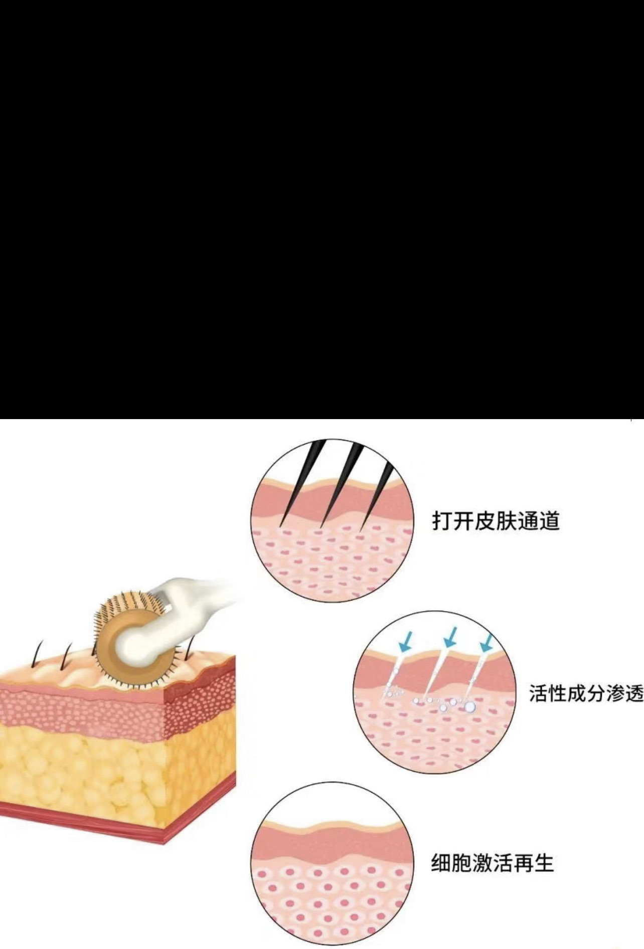 滚轮微针生发教程
