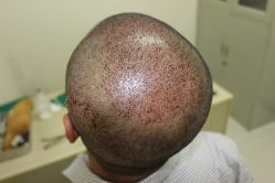 -大麦微针植发丨全国连锁