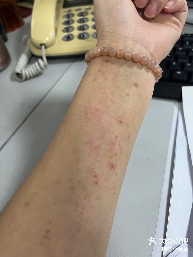 过敏了全身痒该怎么办一个多月不见好