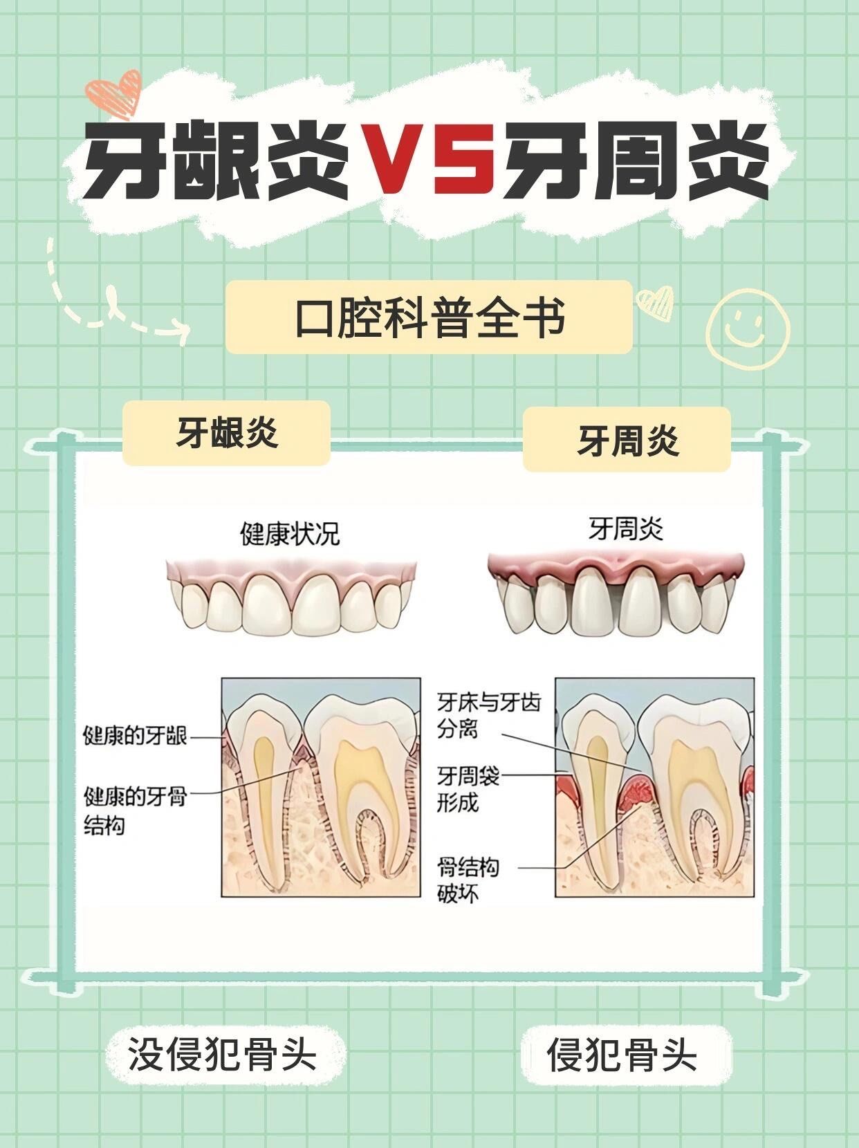 牙周炎vs牙龈炎
