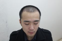 点击看大图 -大麦微针植发丨全国连锁