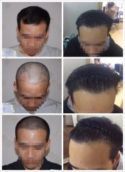 点击看大图 -熙朵美学植发连锁