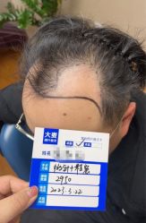 体验前-大麦微针植发全国连锁