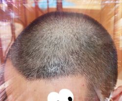 -大麦微针植发全国连锁