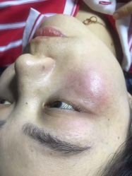 -爱莎扁平疣·汗管瘤·斑痣中心