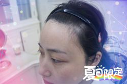 -大麦微针植发全国连锁