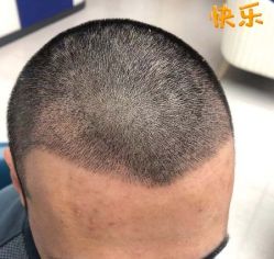 -大麦微针植发丨全国连锁