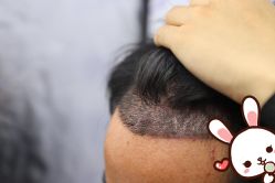 -大麦微针植发丨全国连锁