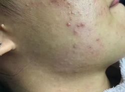 -痘庄科学祛痘国际连锁