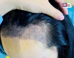 -大麦微针植发丨全国连锁